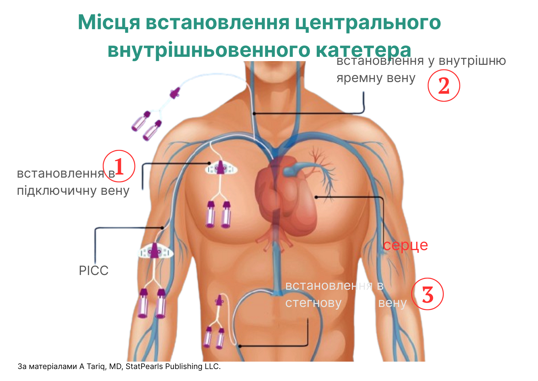 Місця встановлення центральної внутрішньовенної лінії Місця встановлення центральної внутрішньовенної лінії