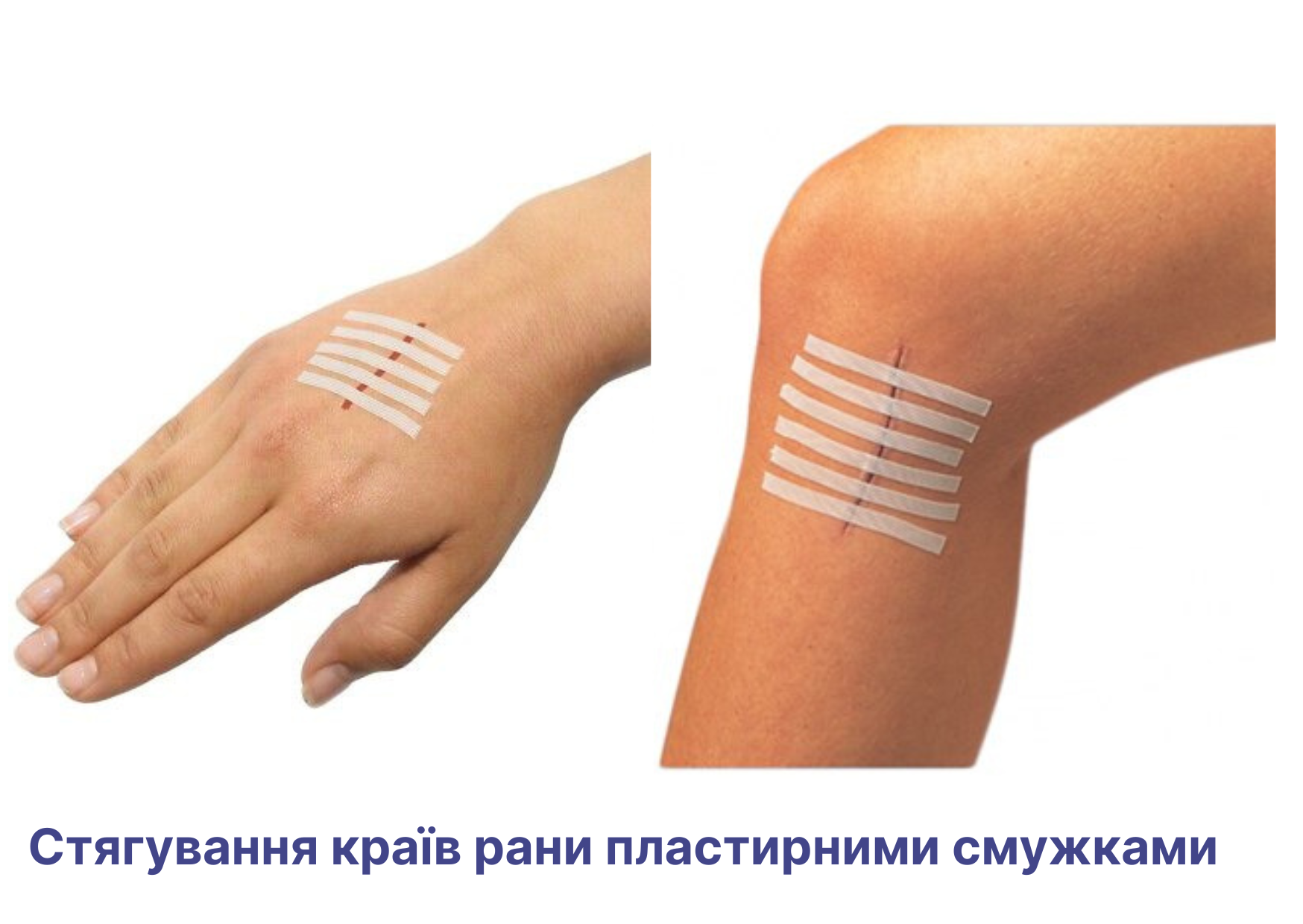 Стягуючі пластирні смужки