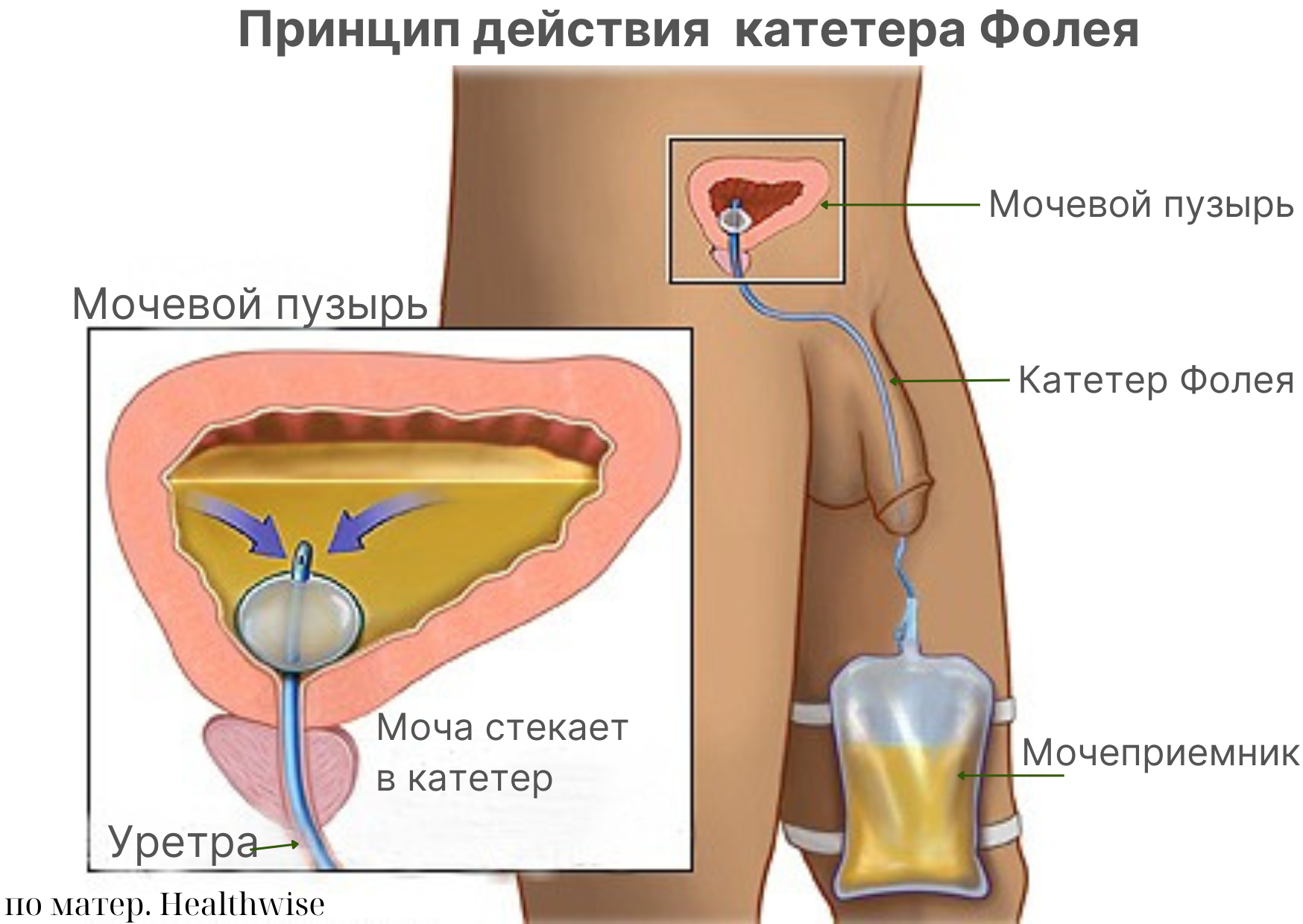 Принцип действия катетера Фолея