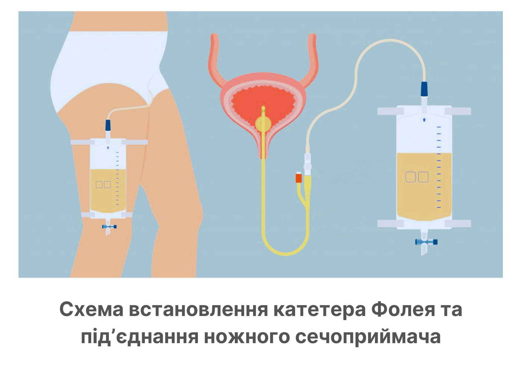 Сечовий катетер Фолея установка для виведення сечі