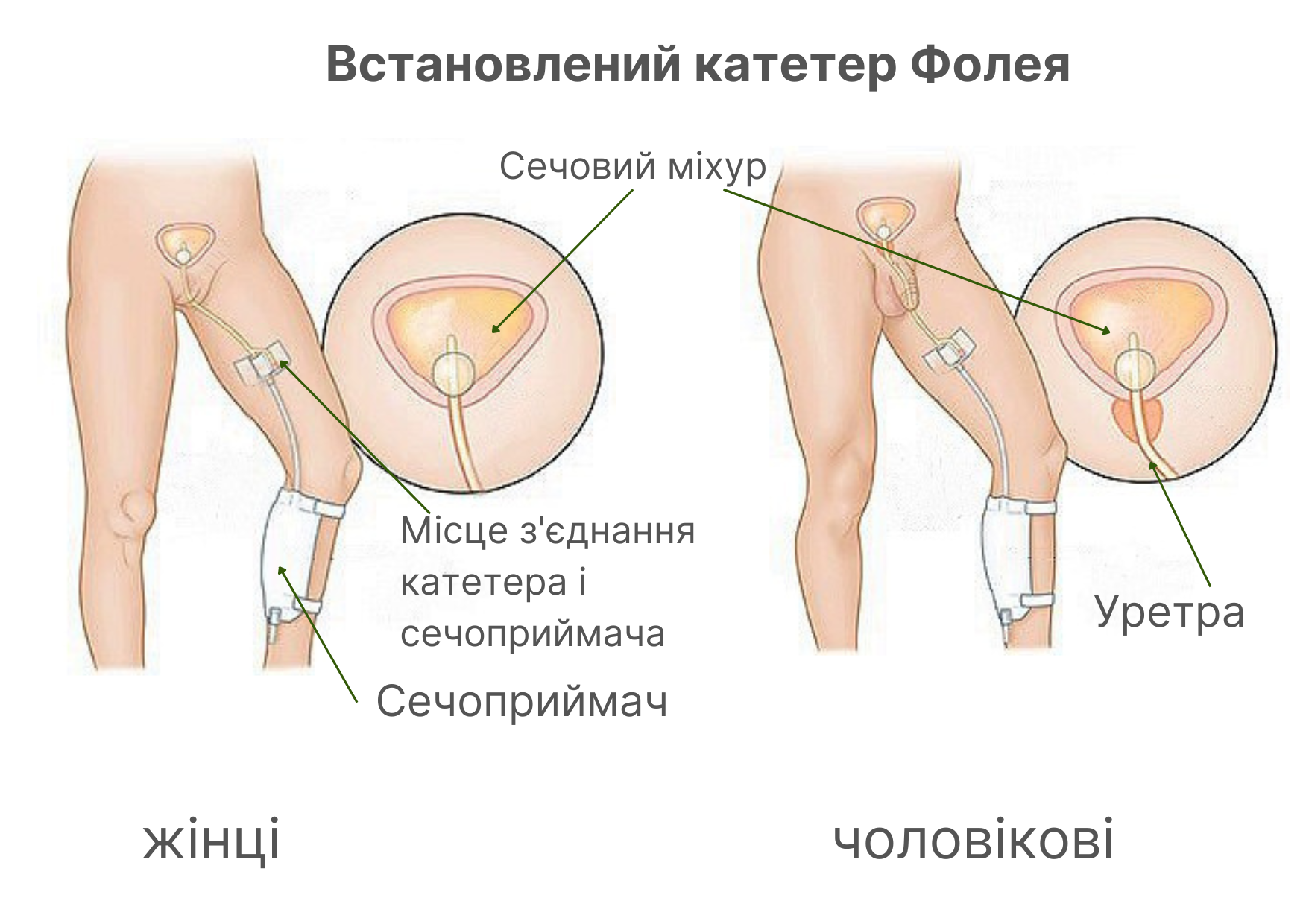 Установленній катетер Фолея