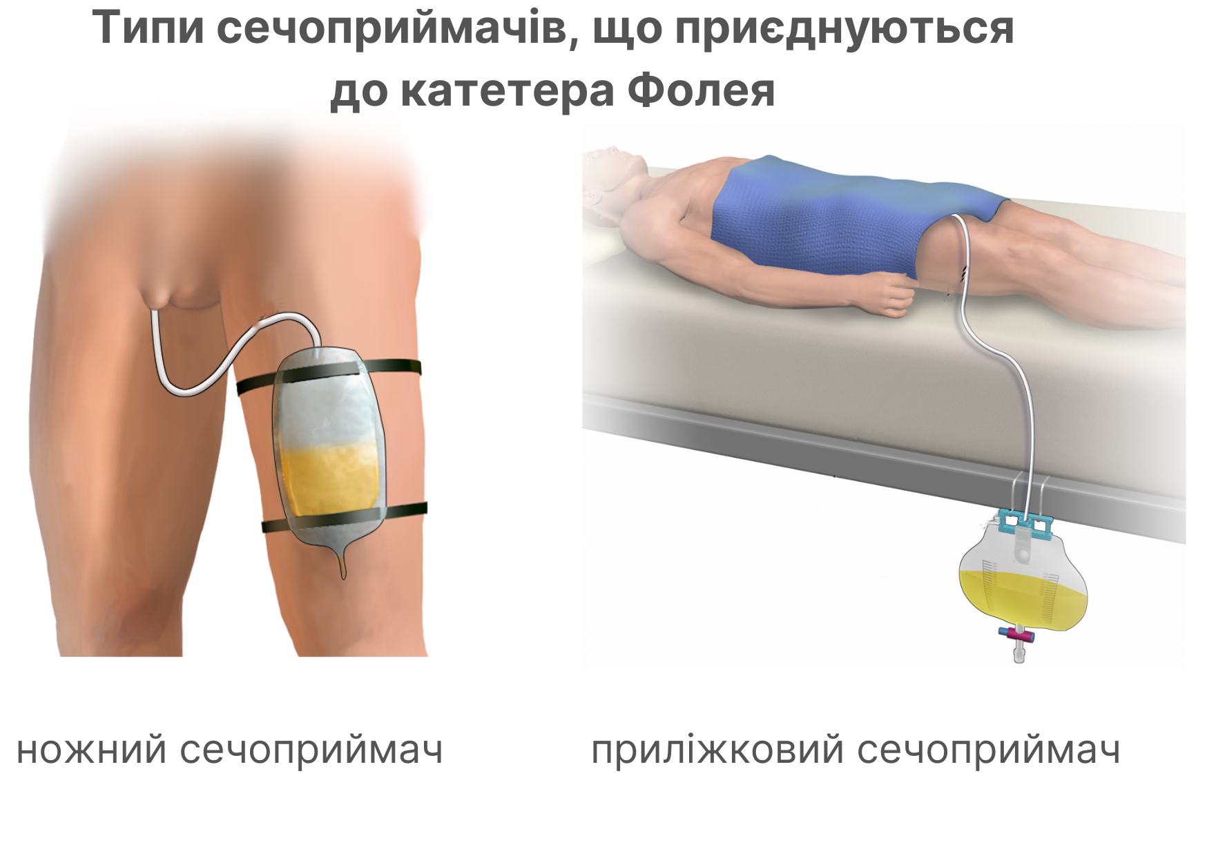 Типи сечоприймачів, що під'єднуються до катетера Фолея Типи сечоприймачів, що під'єднуються до катетера Фолея